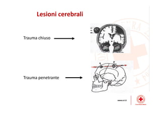 Lesioni cerebrali
Trauma chiuso
Trauma penetrante
 