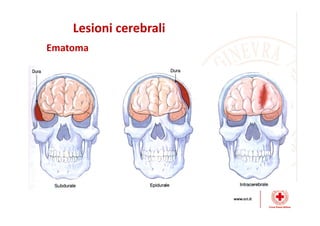 Lesioni cerebrali
Ematoma
 