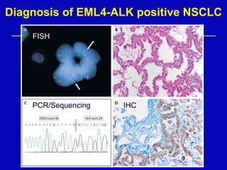 FISH
PCR/Sequencing IHC
Diagnosis of EML4-ALK positive NSCLC
 