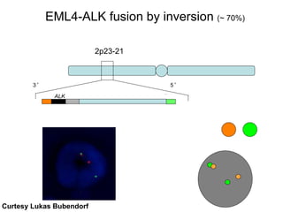 2p23-21
ALK EML4~ 12 Mb
EML4-ALK fusion by inversion (~ 70%)
3‘ 5‘
Curtesy Lukas Bubendorf
 
