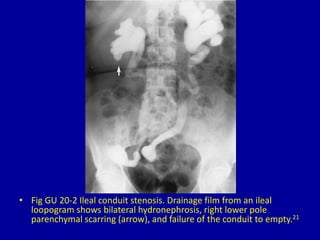 20 ureterectasis | PPTX