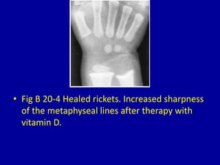 20 zones of increased density in the metaphyses | PPT