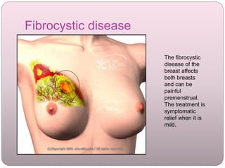 Fibrocystic disease
The fibrocystic
disease of the
breast affects
both breasts
and can be
painful
premenstrual.
The treatment is
symptomatic
relief when it is
mild.
 