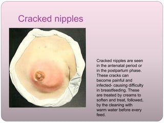 Cracked nipples
Cracked nipples are seen
in the antenatal period or
in the postpartum phase.
These cracks can
become painful and
infected- causing difficulty
in breastfeeding. These
are treated by creams to
soften and treat, followed,
by the cleaning with
warm water before every
feed.
 