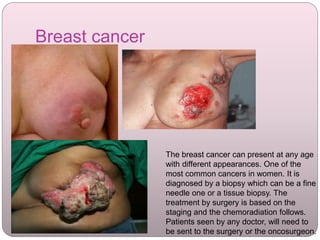Breast cancer
The breast cancer can present at any age
with different appearances. One of the
most common cancers in women. It is
diagnosed by a biopsy which can be a fine
needle one or a tissue biopsy. The
treatment by surgery is based on the
staging and the chemoradiation follows.
Patients seen by any doctor, will need to
be sent to the surgery or the oncosurgeon.
 
