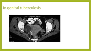 In genital tuberculosis
Magnetic resonance imaging
Magnetic resonance imaging (MRI) findings in genital tuberculosis (TB).
MRI Film showing bilateral tubo-ovarian masses in a confirmed case of
genitalTB
 