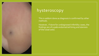 hysteroscopy
• This is seldom done as diagnosis is confirmed by other
methods.
• However, if done for undiagnosed infertility cases, the
findings are of a pale endometrial lining and stenosis
of the tubal ostia.
 