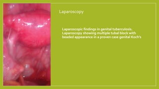 Laparoscopy
• Laparoscopic findings in genital tuberculosis.
Laparoscopy showing multiple tubal block with
beaded appearance in a proven case genital Koch’s
 