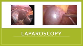LAPAROSCOPY
 