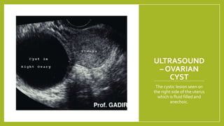 ULTRASOUND
– OVARIAN
CYST
The cystic lesion seen on
the right side of the uterus
which is fluid filled and
anechoic.
 