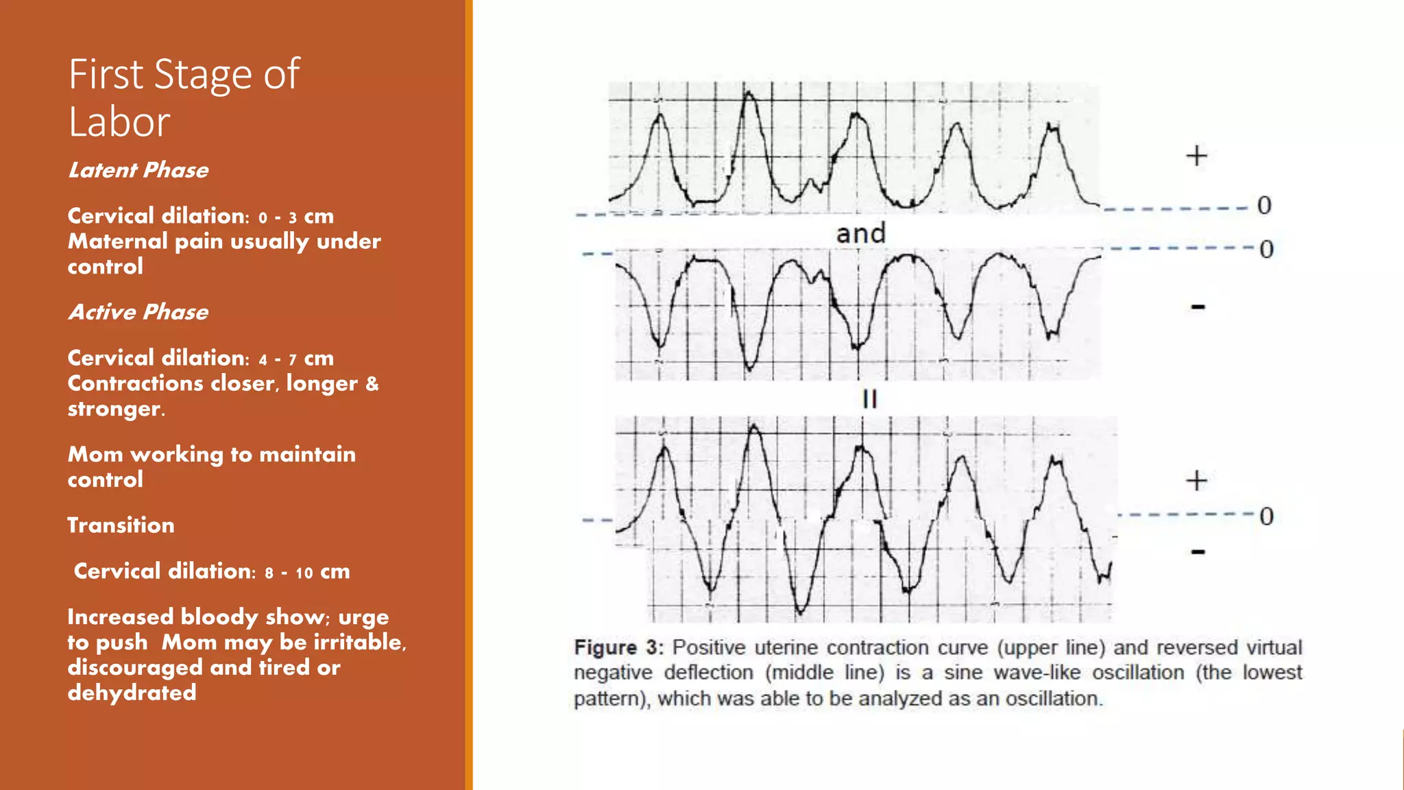 First Stage of
Labor
Latent Phase
Cervical dilation: 0 - 3 cm
Maternal pain usually under
control
Active Phase
Cervical dilation: 4 - 7 cm
Contractions closer, longer &
stronger.
Mom working to maintain
control
Transition
Cervical dilation: 8 - 10 cm
Increased bloody show; urge
to push Mom may be irritable,
discouraged and tired or
dehydrated
 