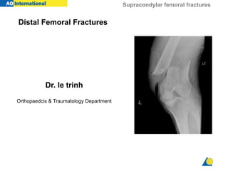 Supracondylar femoral fractures
Distal Femoral Fractures
Dr. le trinh
Orthopaedcis & Traumatology Department
 