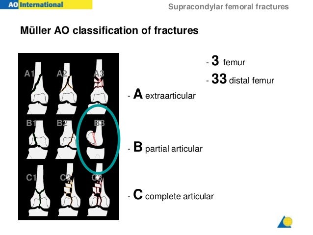 distal femur fracture
