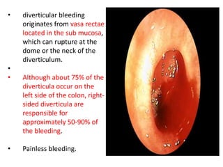 • diverticular bleeding
originates from vasa rectae
located in the sub mucosa,
which can rupture at the
dome or the neck of the
diverticulum.
•
• Although about 75% of the
diverticula occur on the
left side of the colon, right-
sided diverticula are
responsible for
approximately 50-90% of
the bleeding.
• Painless bleeding.
 