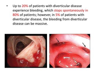 • Up to 20% of patients with diverticular disease
experience bleeding, which stops spontaneously in
80% of patients; however, in 5% of patients with
diverticular disease, the bleeding from diverticular
disease can be massive.
 