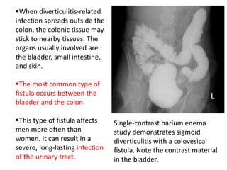 When diverticulitis-related
infection spreads outside the
colon, the colonic tissue may
stick to nearby tissues. The
organs usually involved are
the bladder, small intestine,
and skin.
The most common type of
fistula occurs between the
bladder and the colon.
This type of fistula affects
men more often than
women. It can result in a
severe, long-lasting infection
of the urinary tract.
Single-contrast barium enema
study demonstrates sigmoid
diverticulitis with a colovesical
fistula. Note the contrast material
in the bladder.
 