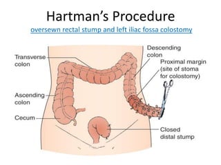Hartman’s Procedure
oversewn rectal stump and left iliac fossa colostomy
 