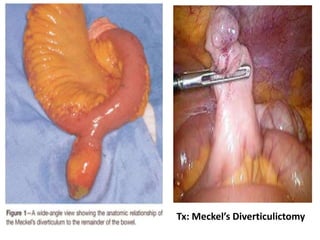 Tx: Meckel’s Diverticulictomy
 