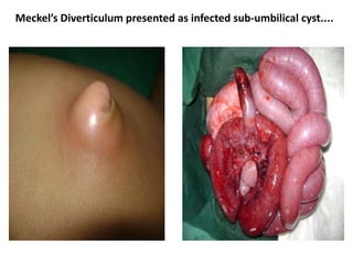 Meckel’s Diverticulum presented as infected sub-umbilical cyst....
 