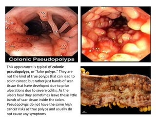 This appearance is typical of colonic
pseudopolyps, or "false polyps." They are
not the kind of true polyps that can lead to
colon cancer, but rather just bands of scar
tissue that have developed due to prior
ulcerations due to severe colitis. As the
ulcers heal they sometimes leave these little
bands of scar tissue inside the colon.
Pseudopolyps do not have the same high
cancer risks as true polyps and usually do
not cause any symptoms
 