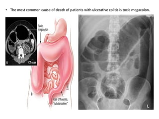 • The most common cause of death of patients with ulcerative colitis is toxic megacolon.
 