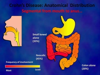 Crohn’s Disease: Anatomical Distribution
Segmental from mouth to anus…
Small bowel
alone
(33%)
Ileocolic
(45%)
Colon alone
(20%)
Frequency of involvement
Most Least
 