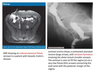 MRI showing an enterocutaneous fistula
(arrow) in a patient with ileocolic Crohn's
disease.
contrast enema shows a contracted ulcerated
rectum (large arrow), with stricture formation
involving the distal rectum (smaller arrows).
The contrast is seen to fill the vagina (v) via a
very low fistula (thin arrows) connecting the
anal canal with the posterior margin of the
vagina.
 