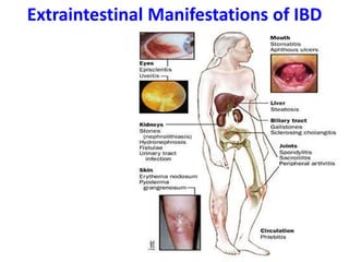 Extraintestinal Manifestations of IBD
Skin
Erythema nodosum
Pyoderma gangrenosum
Joints
Peripheral arthritis
Sacroileitis
Ankylosing spondylitis
Eye
Uveitis
Episcleritis
Iritis
Hepatobiliary
Gallstones
PSC
Renal
Nephrolithiasis
Recurrent UTIs
 