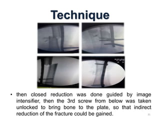 Minimally Invasive Plate Osteosynthesis in pediateric femoral shaft ...