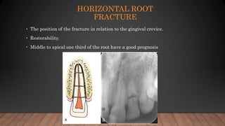 HORIZONTAL ROOT
FRACTURE
• The position of the fracture in relation to the gingival crevice.
• Restorability.
• Middle to apical one third of the root have a good prognosis
 