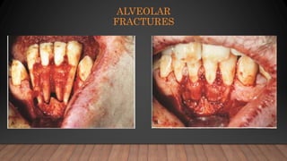 ALVEOLAR
FRACTURES
 