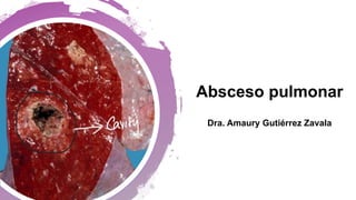 Absceso pulmonar
Dra. Amaury Gutiérrez Zavala
 