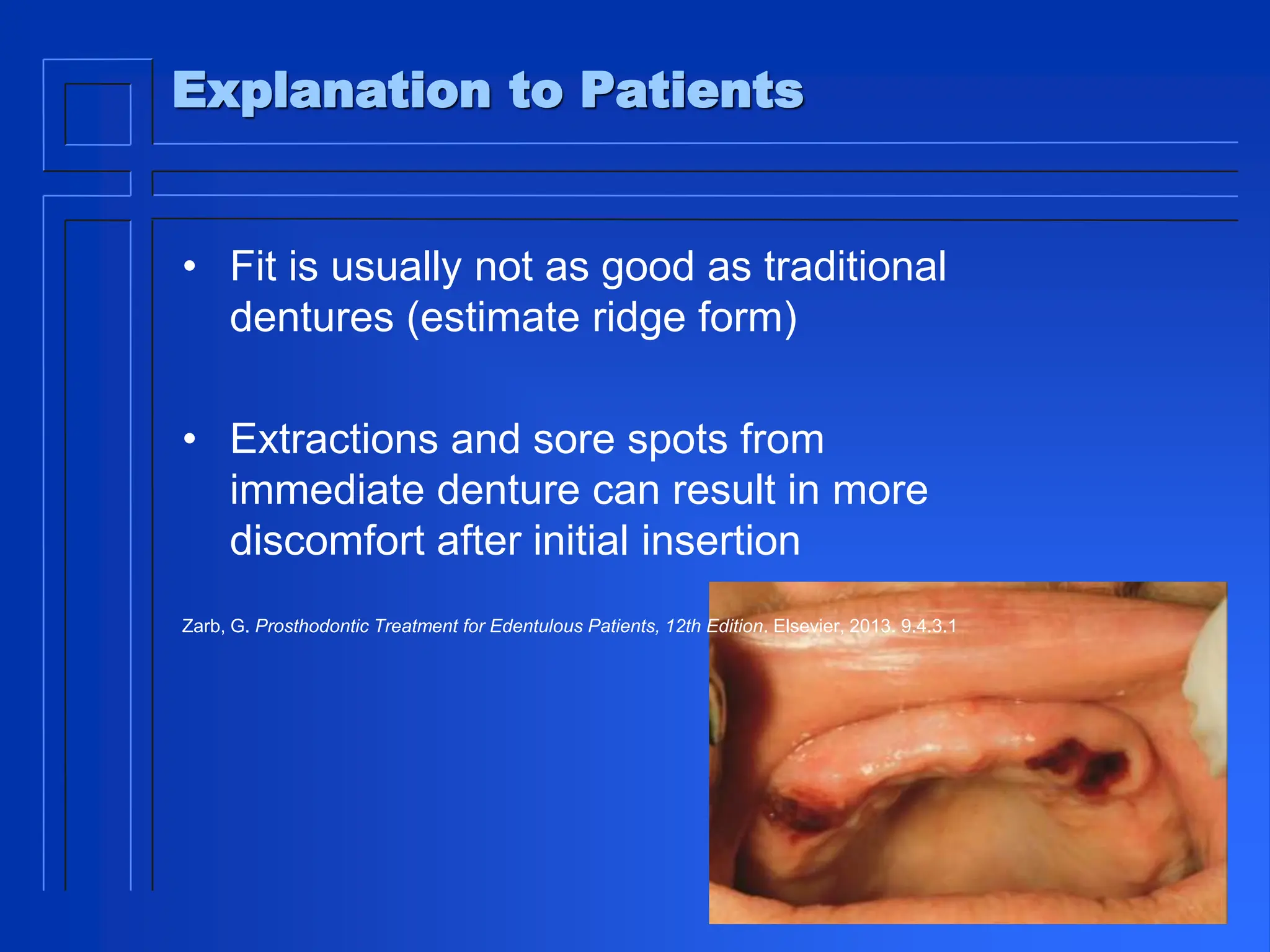 Explanation to Patients
• Fit is usually not as good as traditional
dentures (estimate ridge form)
• Extractions and sore spots from
immediate denture can result in more
discomfort after initial insertion
Zarb, G. Prosthodontic Treatment for Edentulous Patients, 12th Edition. Elsevier, 2013. 9.4.3.1
 