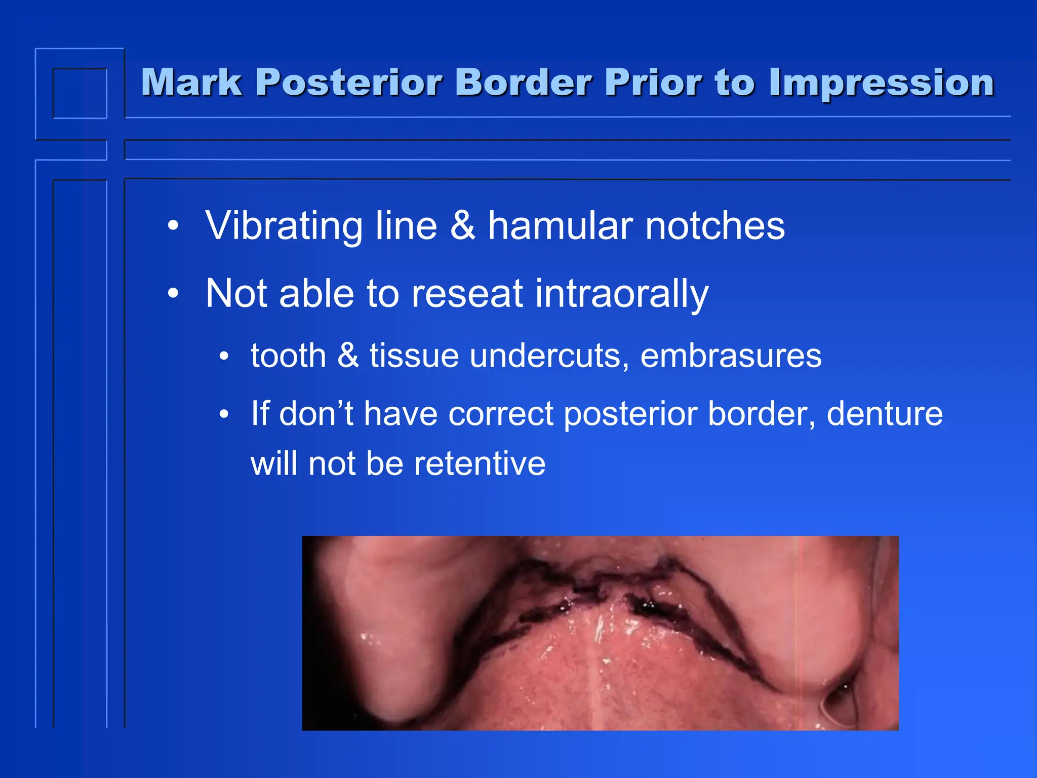 Mark Posterior Border Prior to Impression
• Vibrating line & hamular notches
• Not able to reseat intraorally
• tooth & tissue undercuts, embrasures
• If don’t have correct posterior border, denture
will not be retentive
 