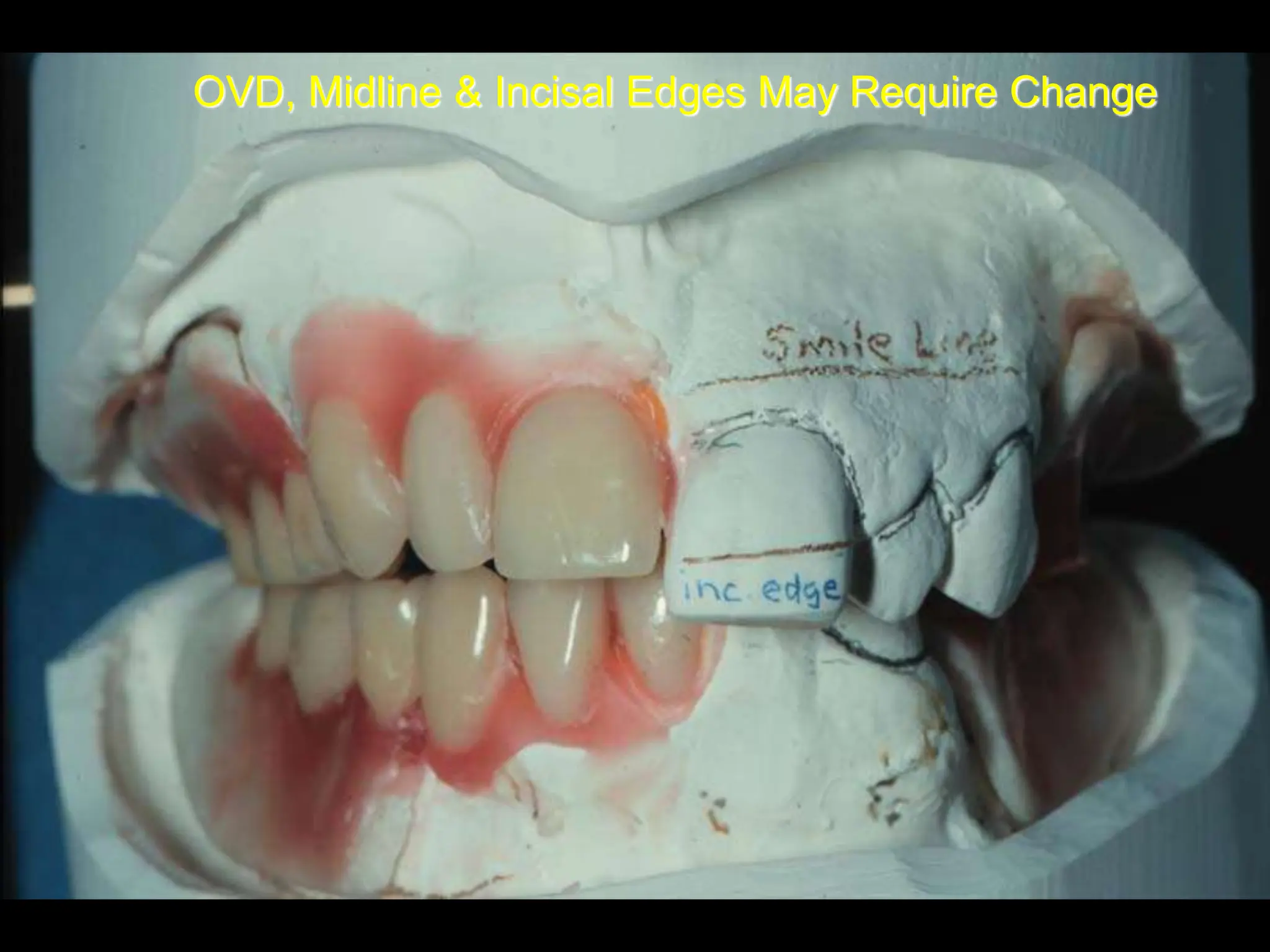 OVD, Midline & Incisal Edges May Require Change
 