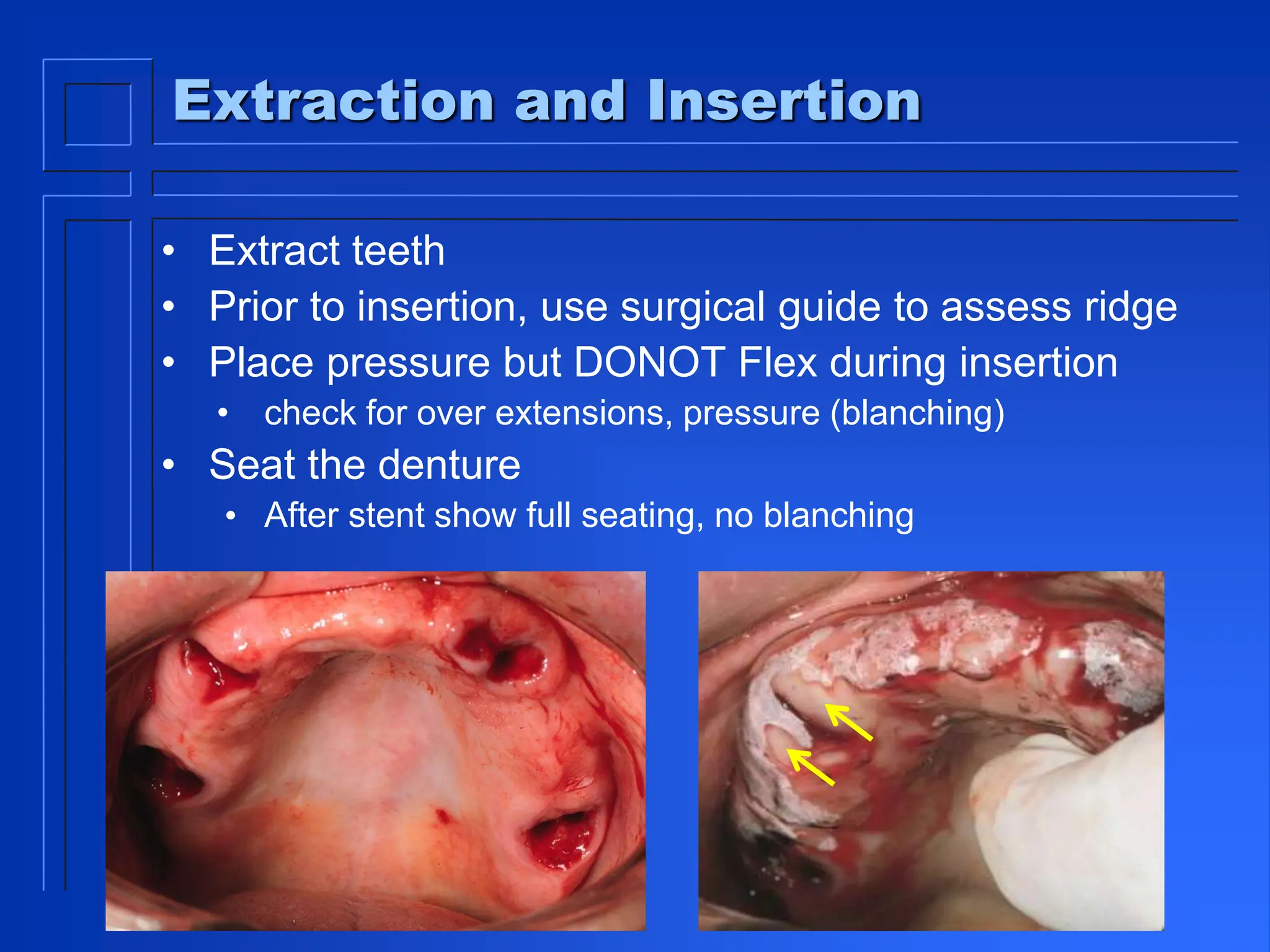 Extraction and Insertion
• Extract teeth
• Prior to insertion, use surgical guide to assess ridge
• Place pressure but DONOT Flex during insertion
• check for over extensions, pressure (blanching)
• Seat the denture
• After stent show full seating, no blanching
 