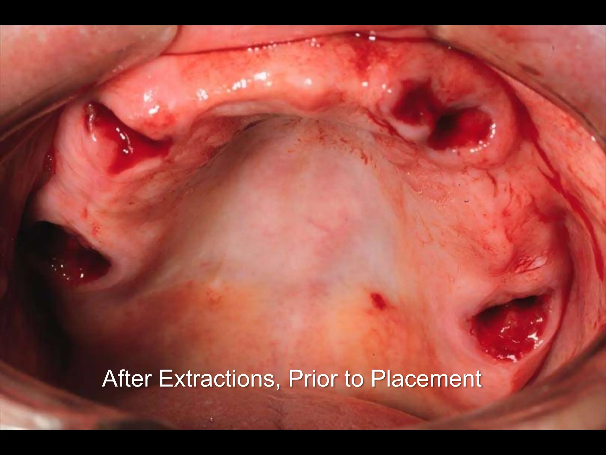 After Extractions, Prior to Placement
 