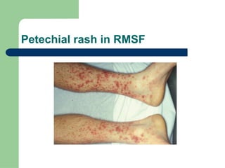 Rash Of Rmsf Comprehensive Overview of Rickettsia: Pathogenesis, Clinical Features ...