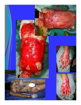 Extraction Burn Early excision and grafting for burns | PDF