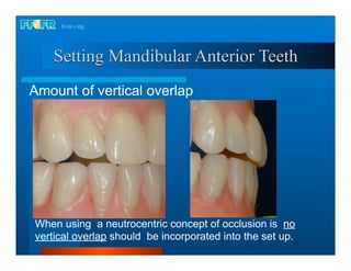 21.occlusal schemes monoplane with balancing ramps | PDF