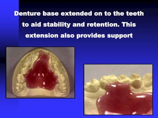 Denture base extended on to the teeth
to aid stability and retention. This
extension also provides support
 