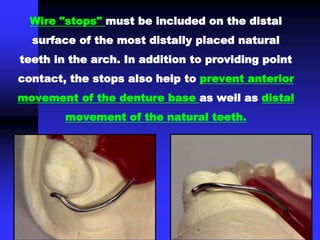 Wire "stops" must be included on the distal
surface of the most distally placed natural
teeth in the arch. In addition to providing point
contact, the stops also help to prevent anterior
movement of the denture base as well as distal
movement of the natural teeth.
 