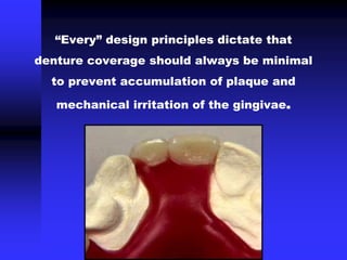“Every” design principles dictate that
denture coverage should always be minimal
to prevent accumulation of plaque and
mechanical irritation of the gingivae.
 