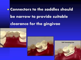  Connectors to the saddles should
be narrow to provide suitable
clearance for the gingivae
 