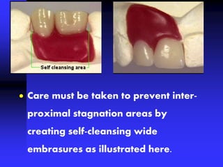  Care must be taken to prevent inter-
proximal stagnation areas by
creating self-cleansing wide
embrasures as illustrated here.
 