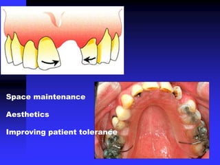 Space maintenance
Aesthetics
Improving patient tolerance
 