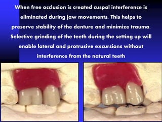 When free occlusion is created cuspal interference is
eliminated during jaw movements: This helps to
preserve stability of the denture and minimize trauma.
Selective grinding of the teeth during the setting up will
enable lateral and protrusive excursions without
interference from the natural teeth
 