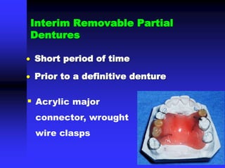 Interim Removable Partial
Dentures
 Short period of time
 Prior to a definitive denture
 Acrylic major
connector, wrought
wire clasps
 