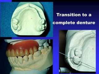 Transition to a
complete denture
 