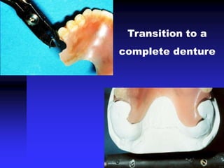 Transition to a
complete denture
 